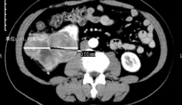 我院首例腹腔鏡下巨大腎癌根治術(shù)獲得成功