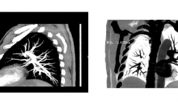 放射科成功开展肺动脉CTA 检查技术